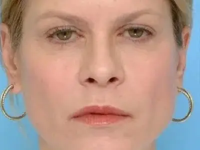 Sculptra 2 – Before Sculptra 2 - Before