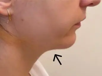 Kybella - After