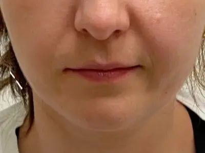Kybella 1 - After
