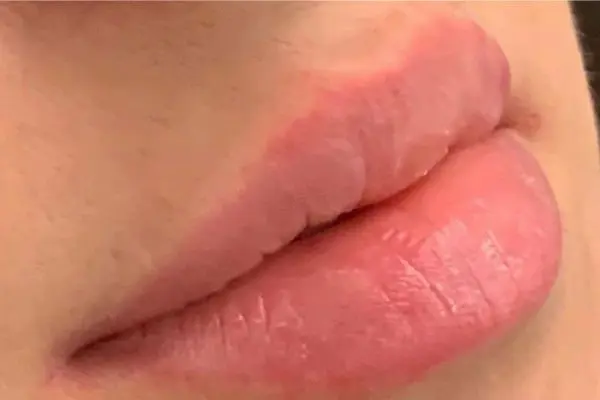 Lip Filler 5 - After