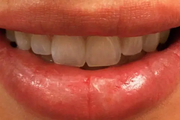 Lip Filler 6 - After