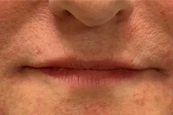 Lip Filler 7 - After