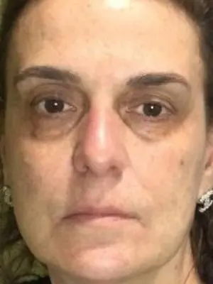 Regenerative Medicine - After