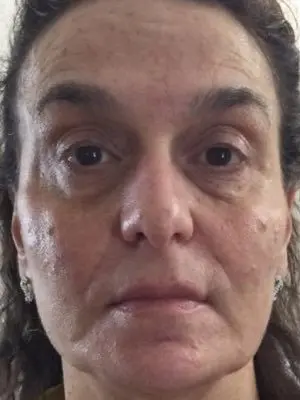 Regenerative Medicine - Before