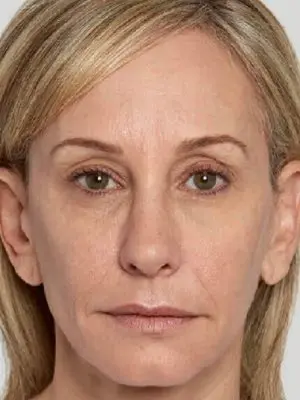 Sculptra 6 - After
