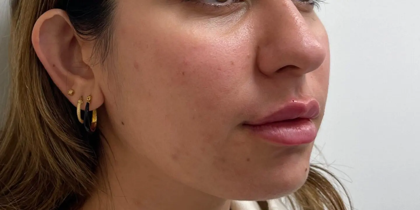 Lip-Filler2-After
