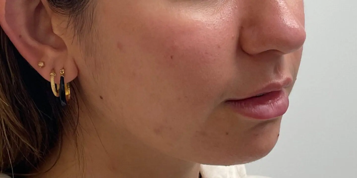 Lip-Filler2-Before