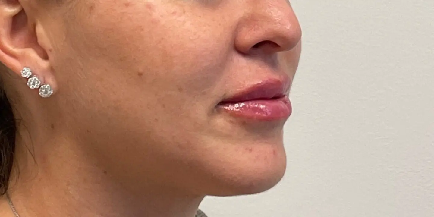 Lip-Fillers1-After