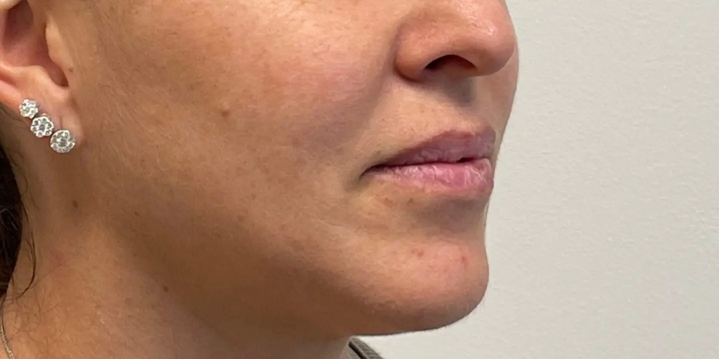 Lip-Fillers1-Before