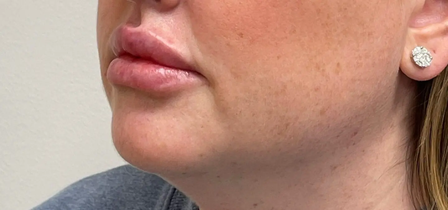 Lip-Fillers10-After