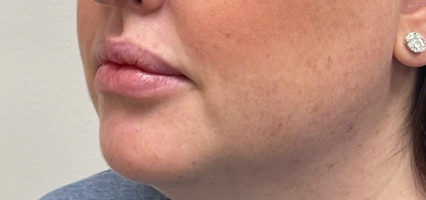 Lip-Fillers10-Before