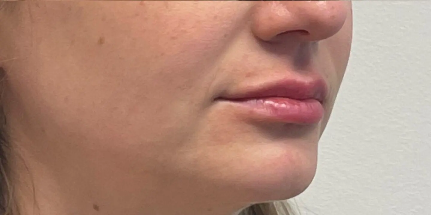 Lip-Fillers11-After