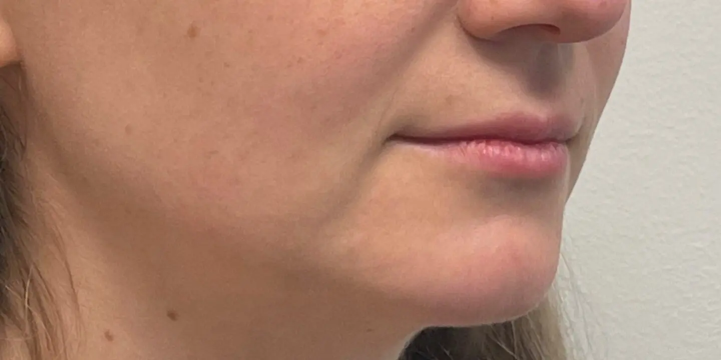 Lip-Fillers11-Before