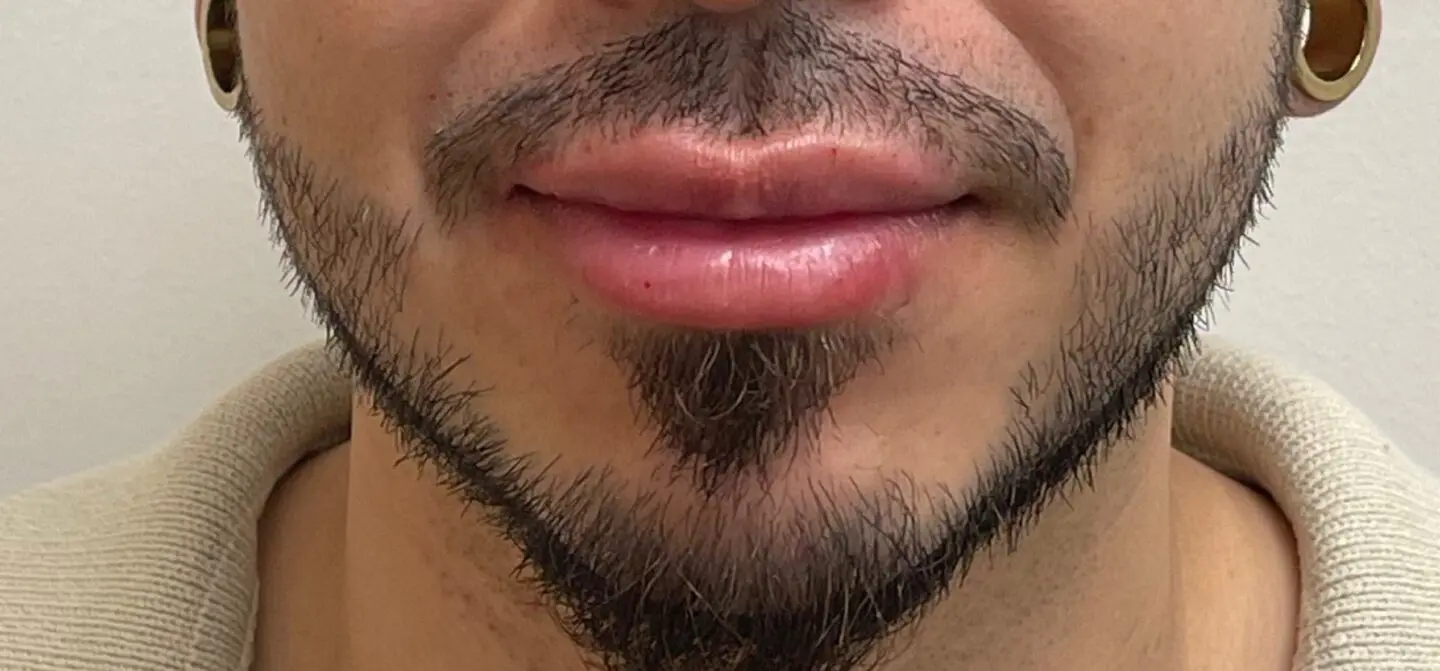 Lip-Fillers14-After