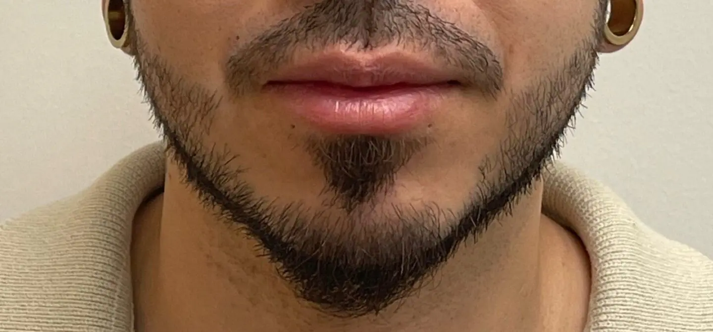 Lip-Fillers14-Before