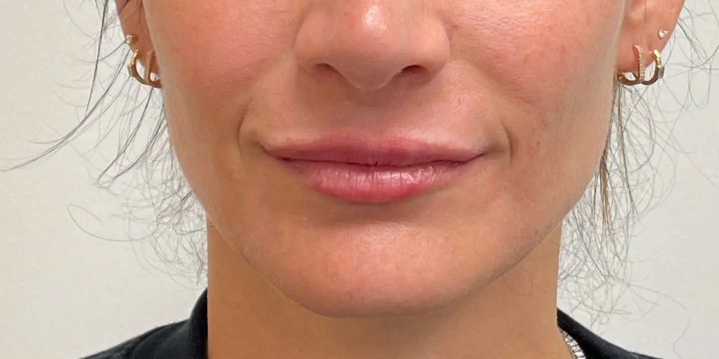 Lip-Fillers15-After