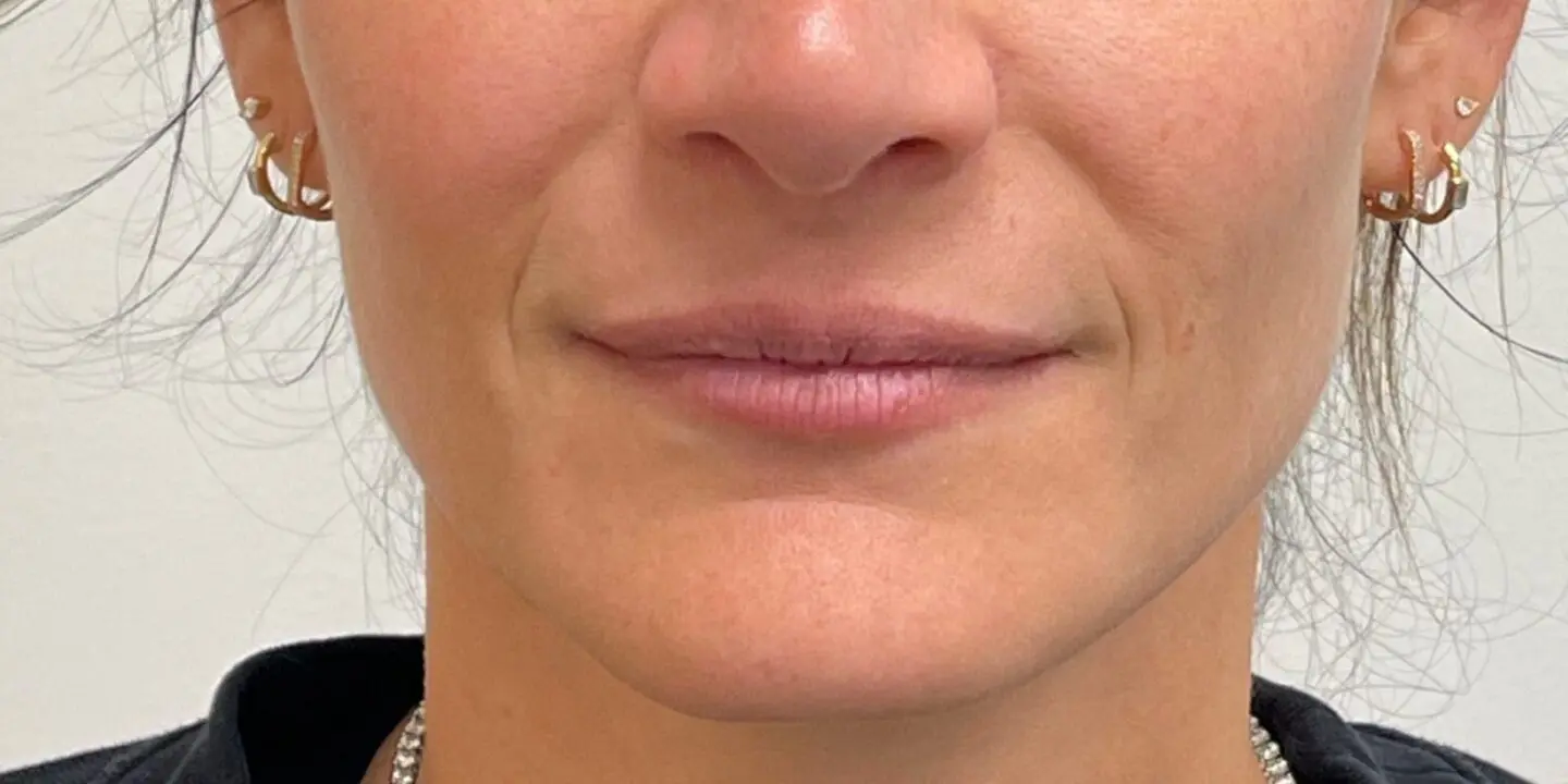 Lip-Fillers15-Before