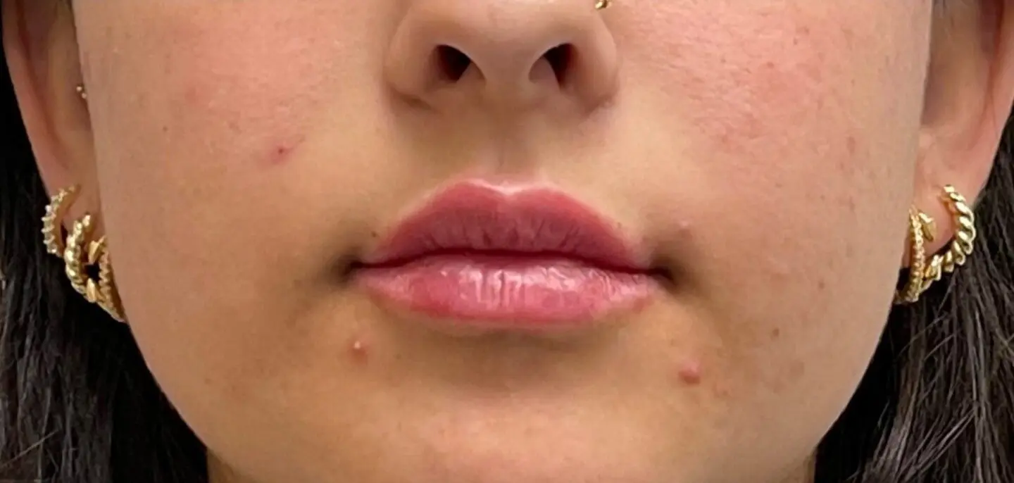Lip-Fillers16-After