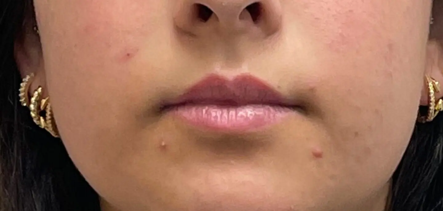Lip-Fillers16-Before