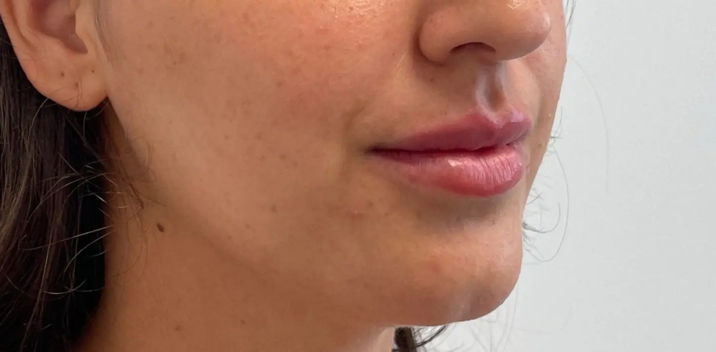 Lip-Fillers17-After