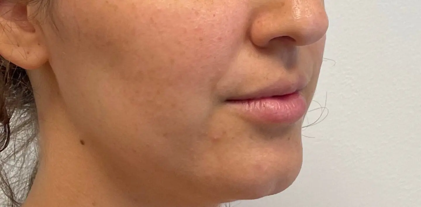 Lip-Fillers17-Before