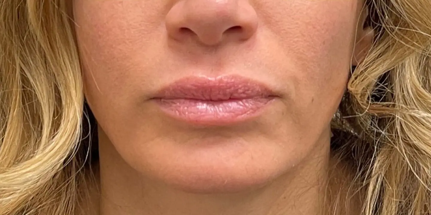 Lip-Fillers18-After