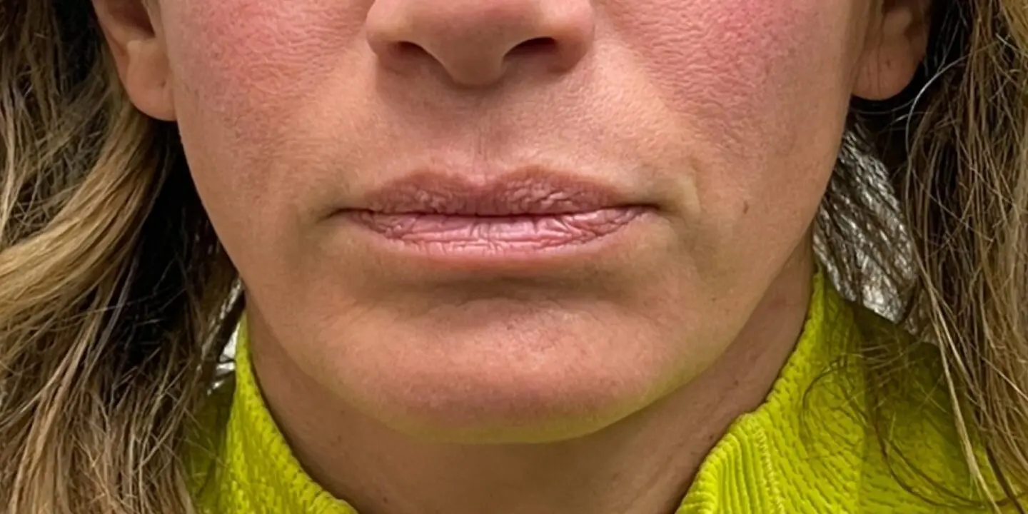 Lip-Fillers18-Before