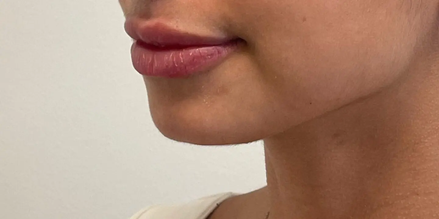 Lip-Fillers19-After