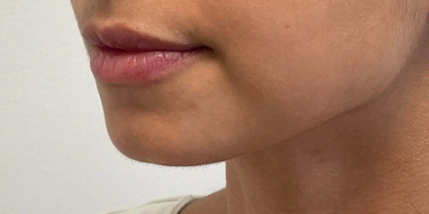 Lip-Fillers19-Before