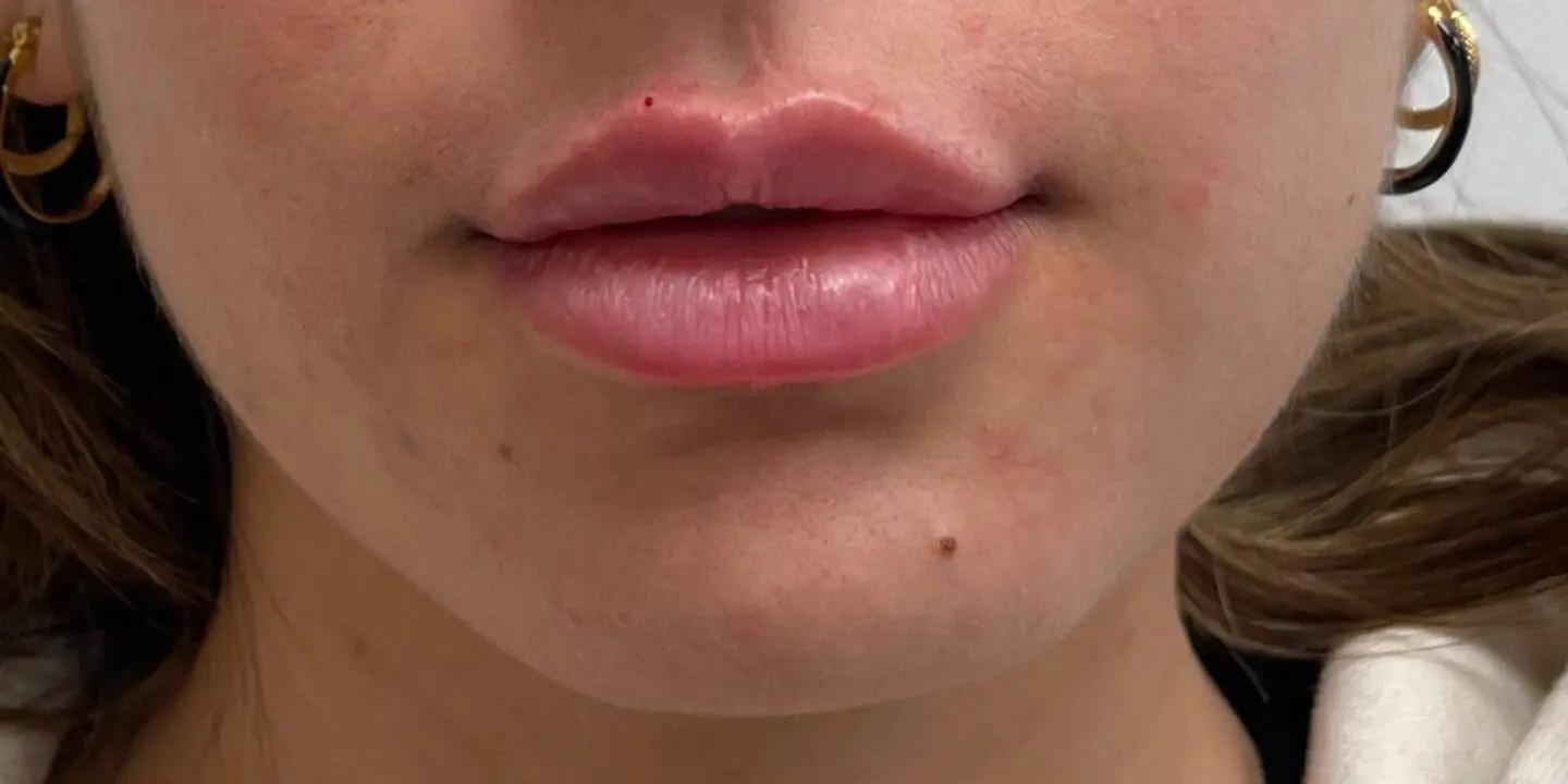 Lip-Fillers21-After