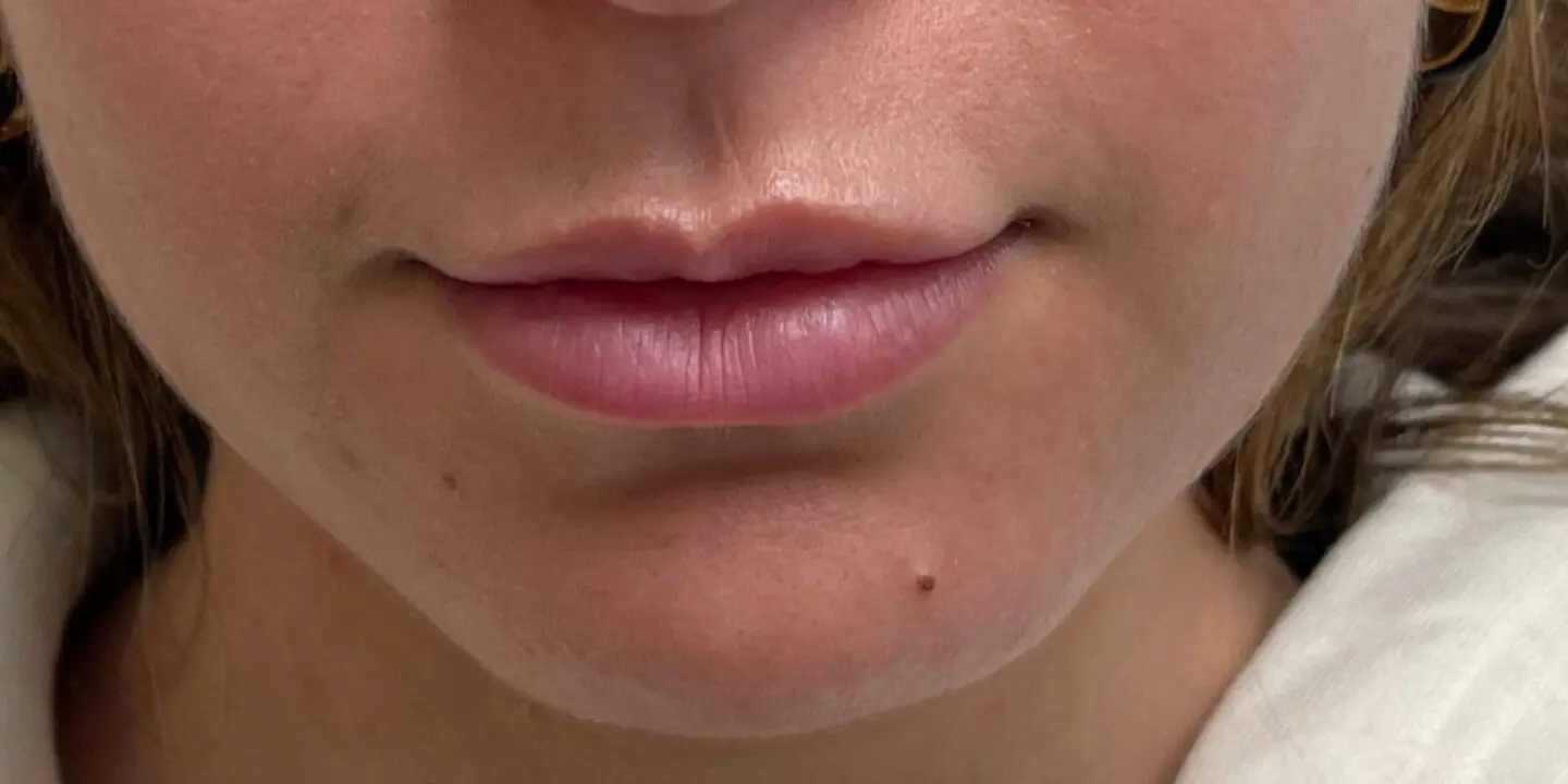 Lip-Fillers21-Before