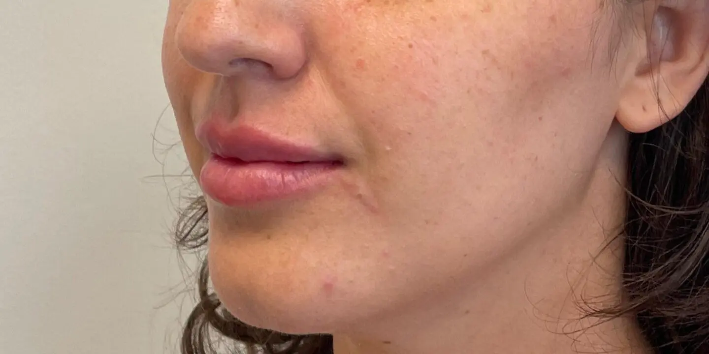 Lip-Fillers3-After