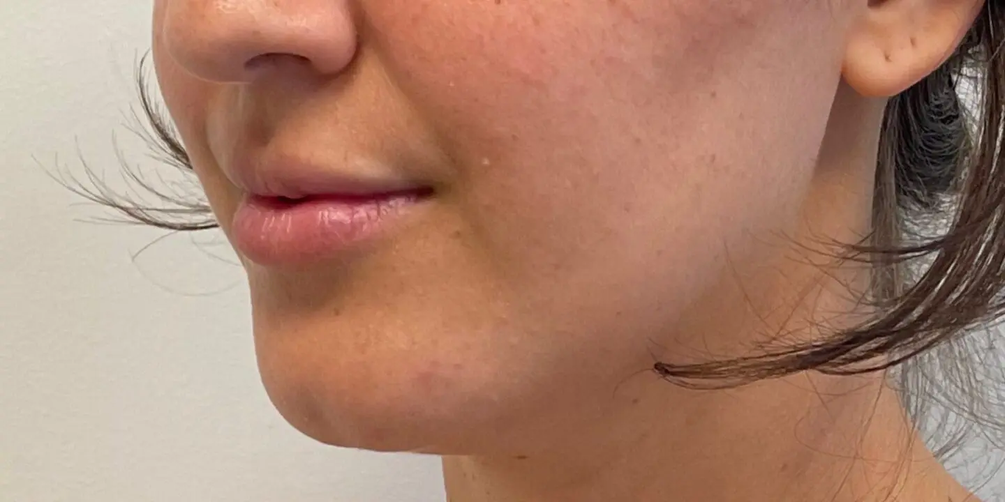 Lip-Fillers3-Before