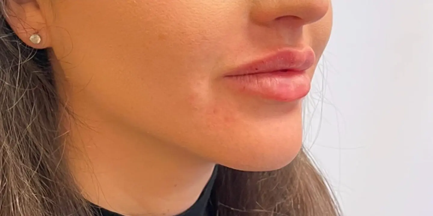 Lip-Fillers4-After