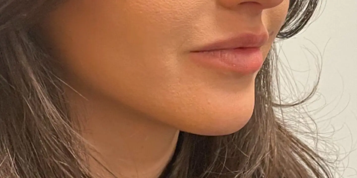 Lip-Fillers4-Before