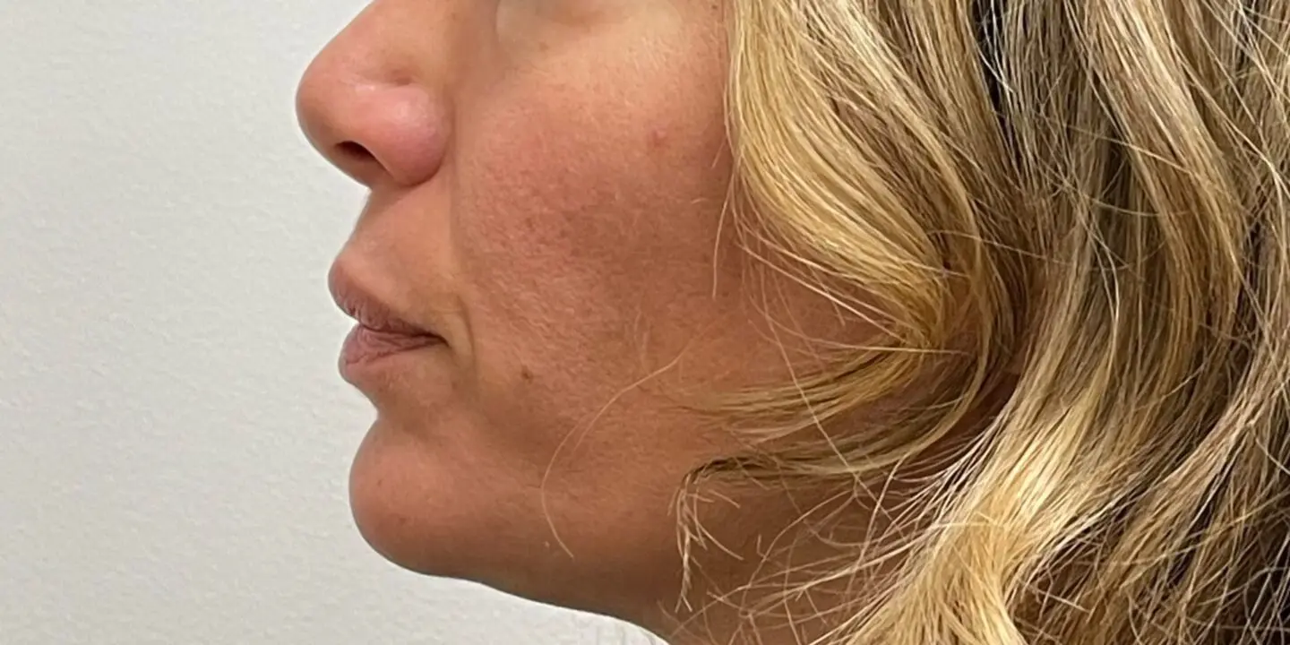 Lip-Fillers7-After