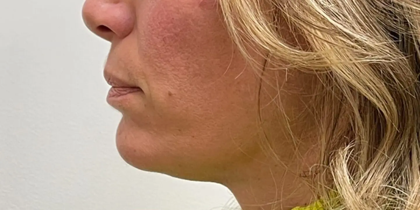 Lip-Fillers7-Before