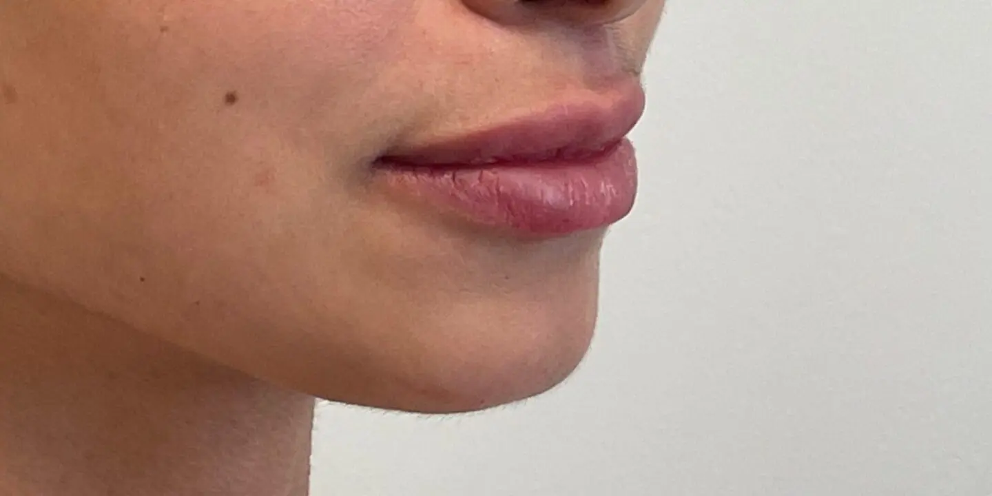 Lip-Fillers8-After