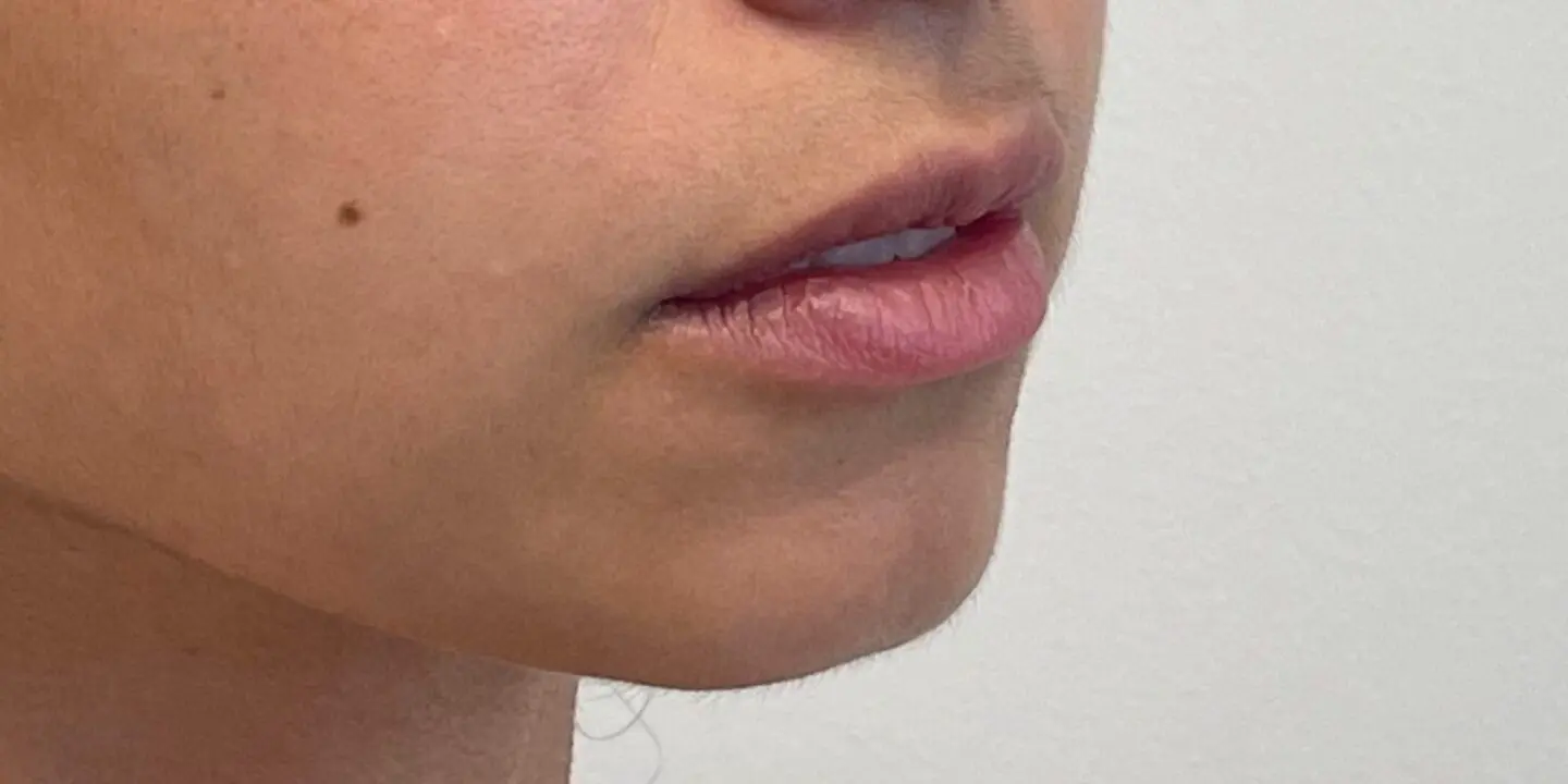 Lip-Fillers8-Before