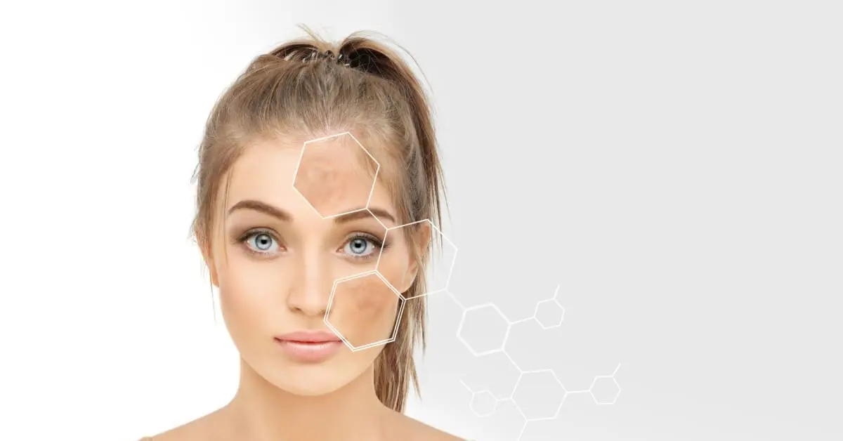 young girl, with dark spots highlighted, concept of BioRePeel vs Chemical Peel by Arria MedSpa, Montclair NJ