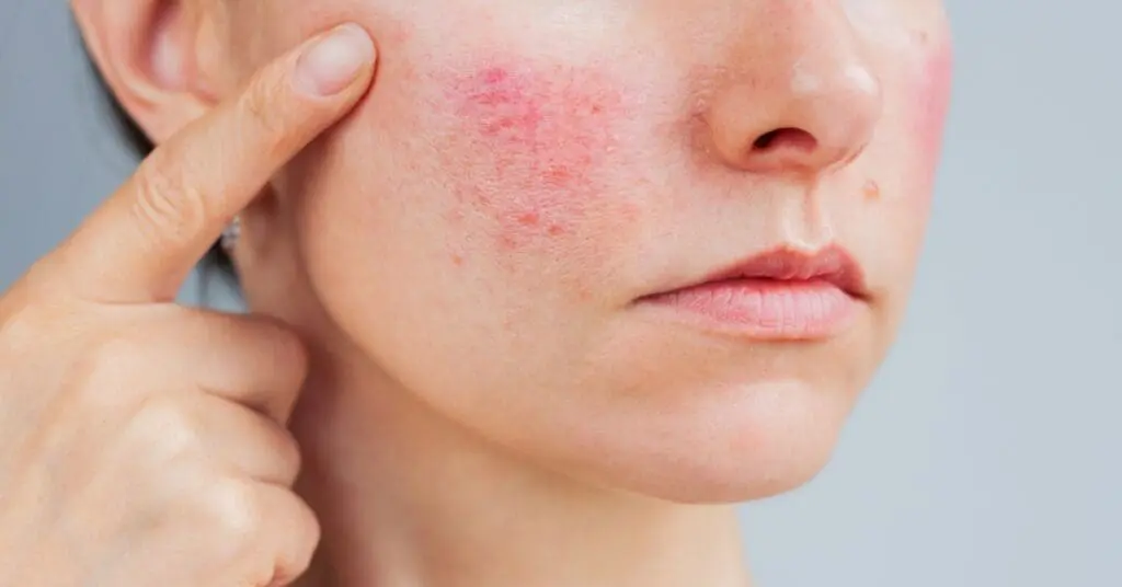 Rosacea On Womans Face