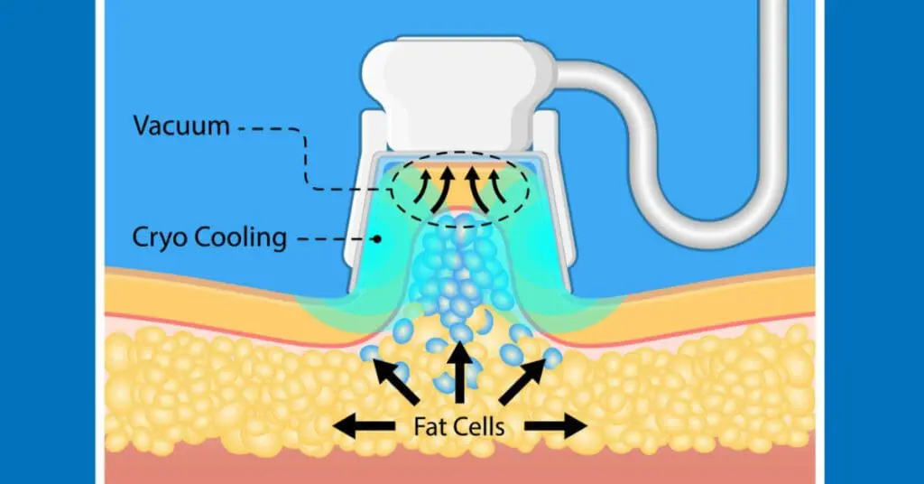 coolsculpting for men body contouring treatment