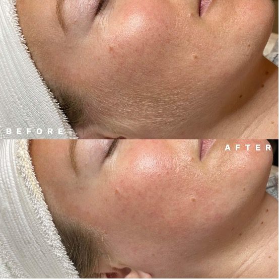 Dermaplaning Treatments Arria MedSpa NJ