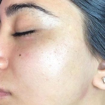 Dermaplaning Treatment After