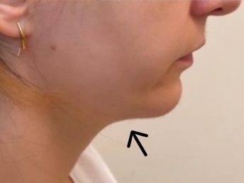 Kybella - After