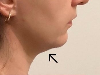 Kybella - Before