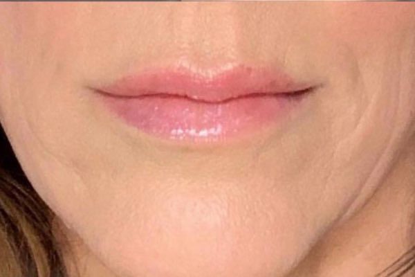 Lip Filler 4 - After