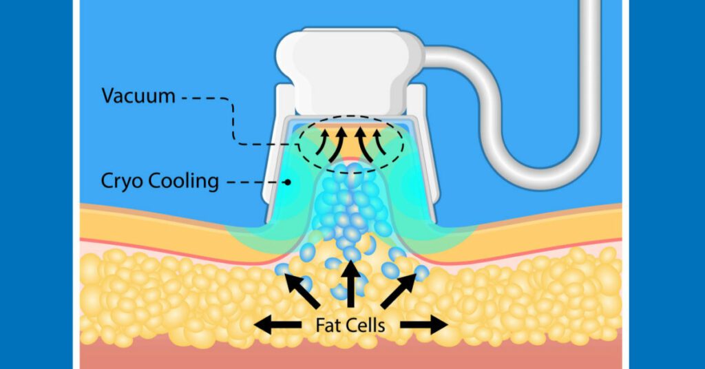 Is Coolsculpting Right For Me?