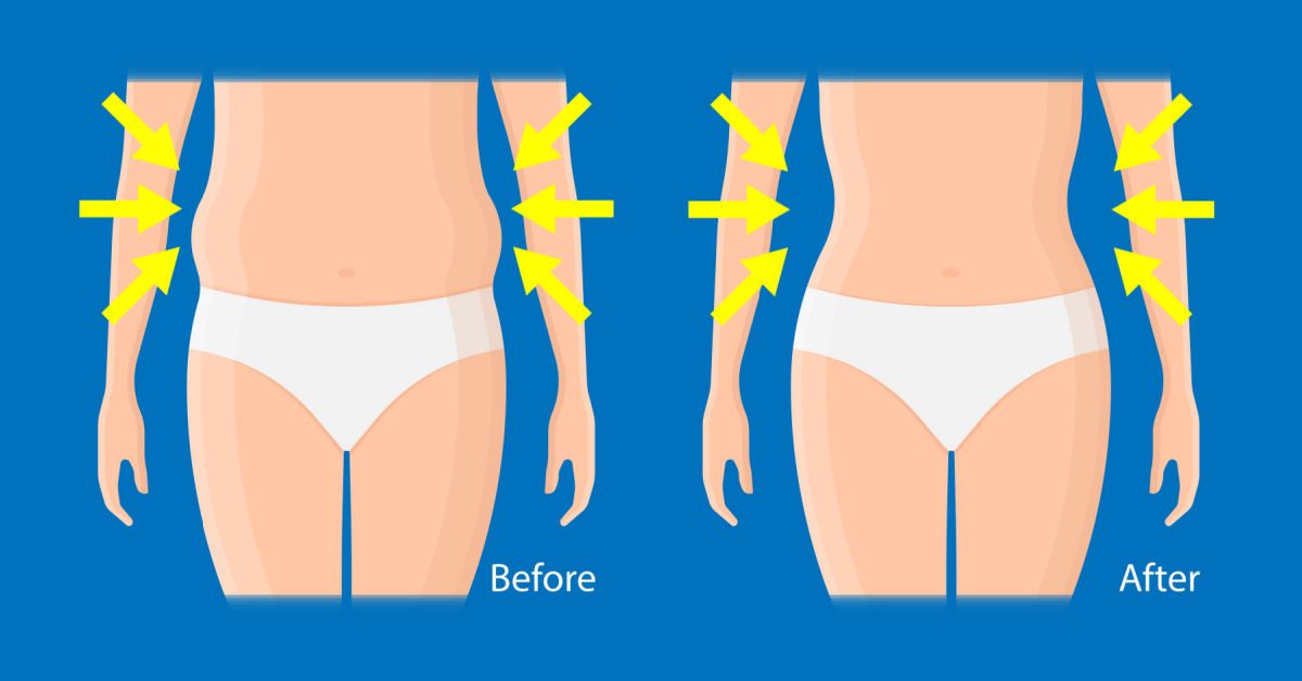 Is Coolsculpting Right For Me?