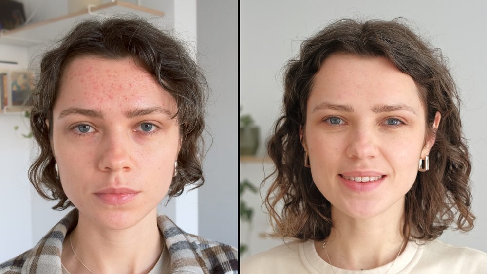 Achieving Clear Skin: How To Get Rid of Acne